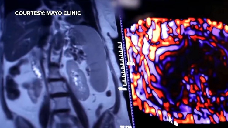 Healthy SA: Battling liver cancer, a disease which often has no symptoms early on — KENS 5 (San Antonio)