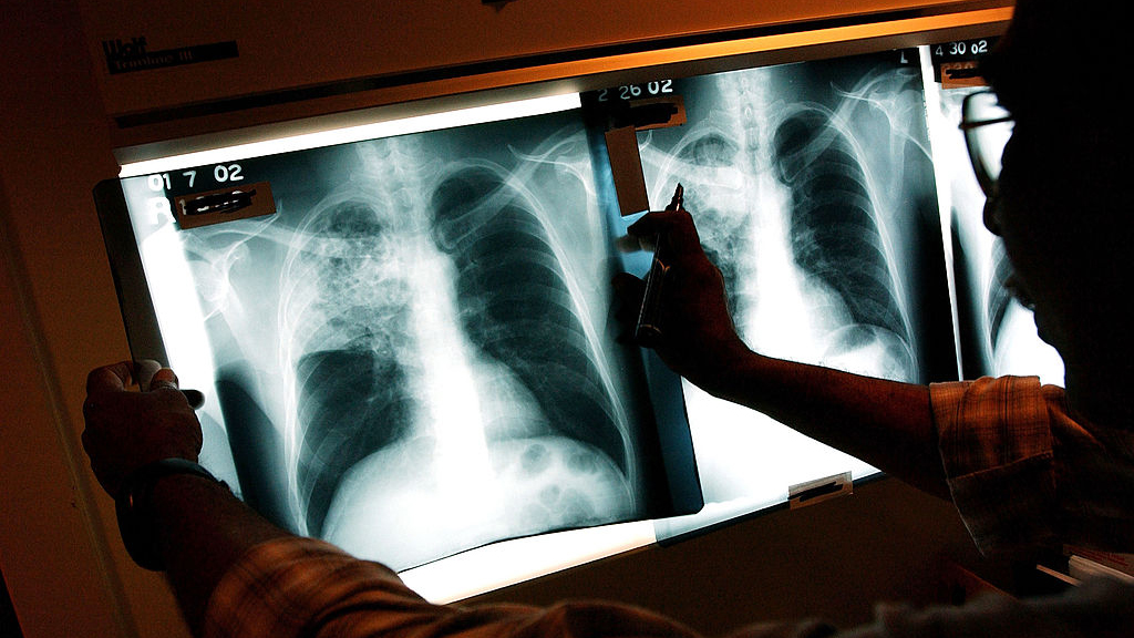 2 active tuberculosis cases traced to San Francisco strip club — KTVU FOX 2 Bay Area, Menlo Park Health news